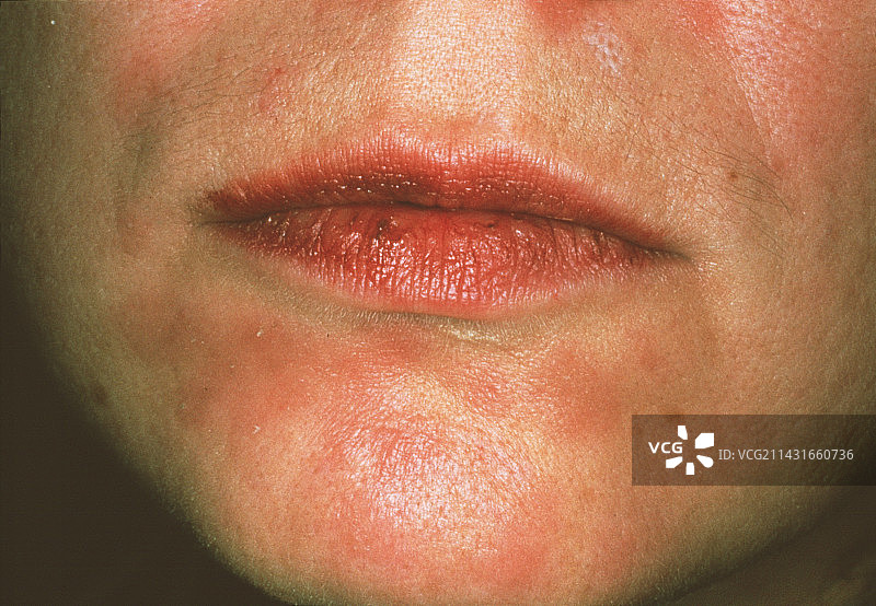 二期梅毒疹图片素材