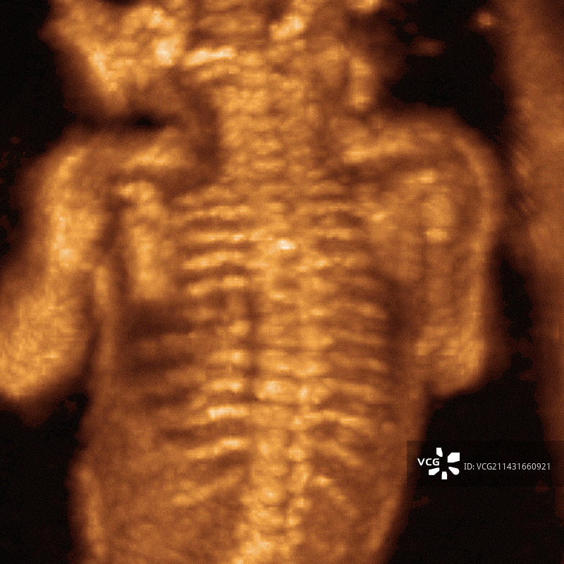 胎儿骨骼3D超声扫描图片素材