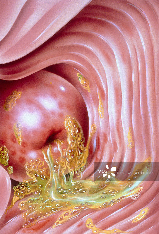 子宫颈毛滴虫插图图片素材