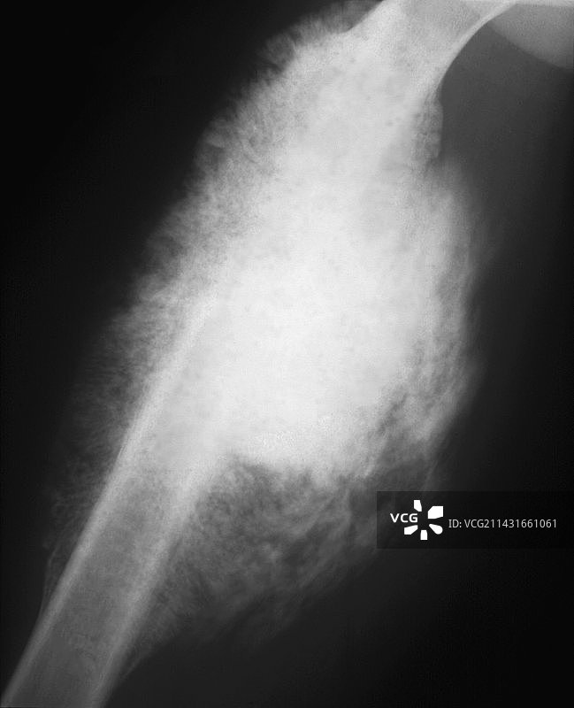 股骨骨癌X光片图片素材