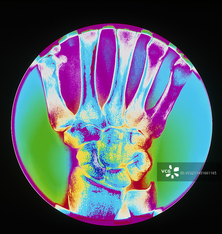 手腕骨骼的彩色X光片图片素材