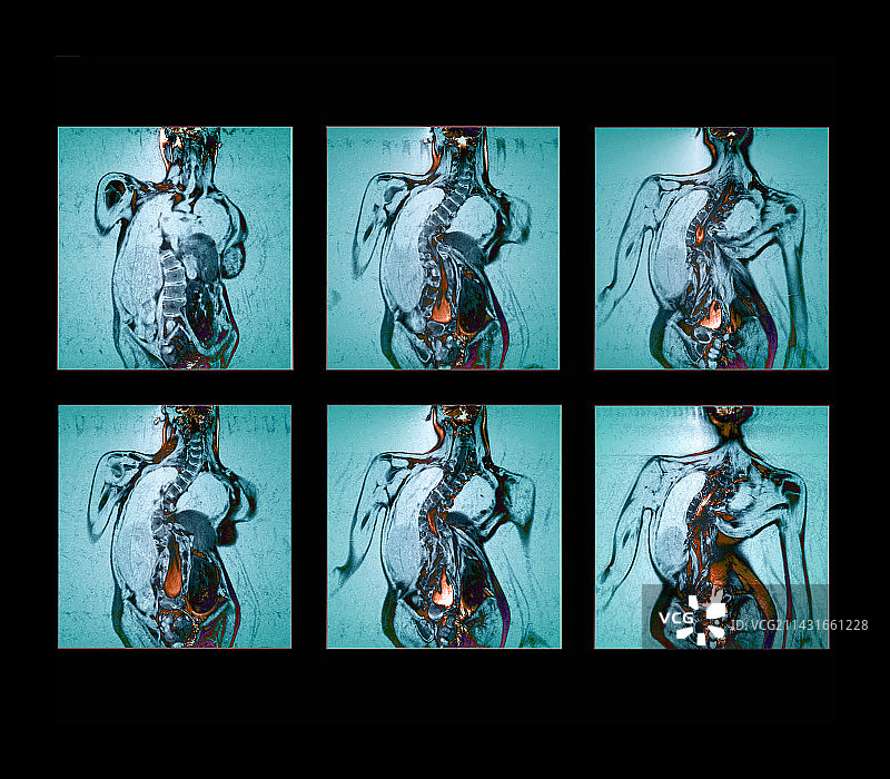 脊柱弯曲核磁共振扫描图片素材