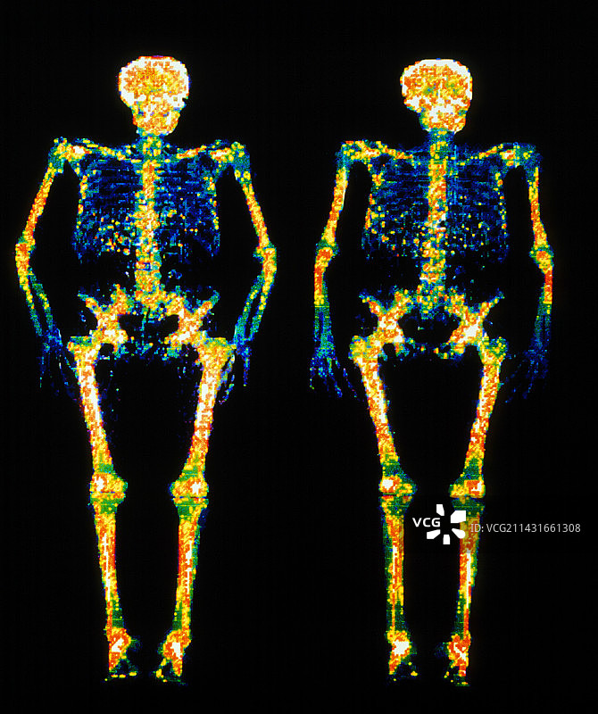 双胞胎骨骼的骨密度扫描图片素材