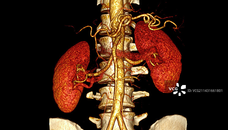 肾脏CT扫描图片素材