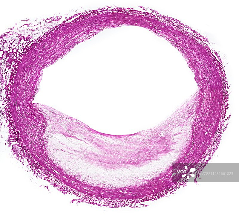 狭窄的动脉，光学显微照片图片素材