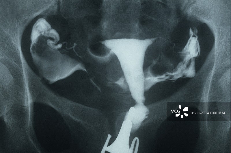 女性生殖系统X光片图片素材