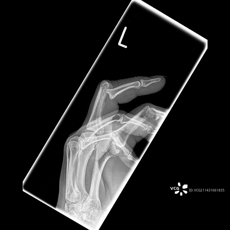 手指脱臼X光片图片素材