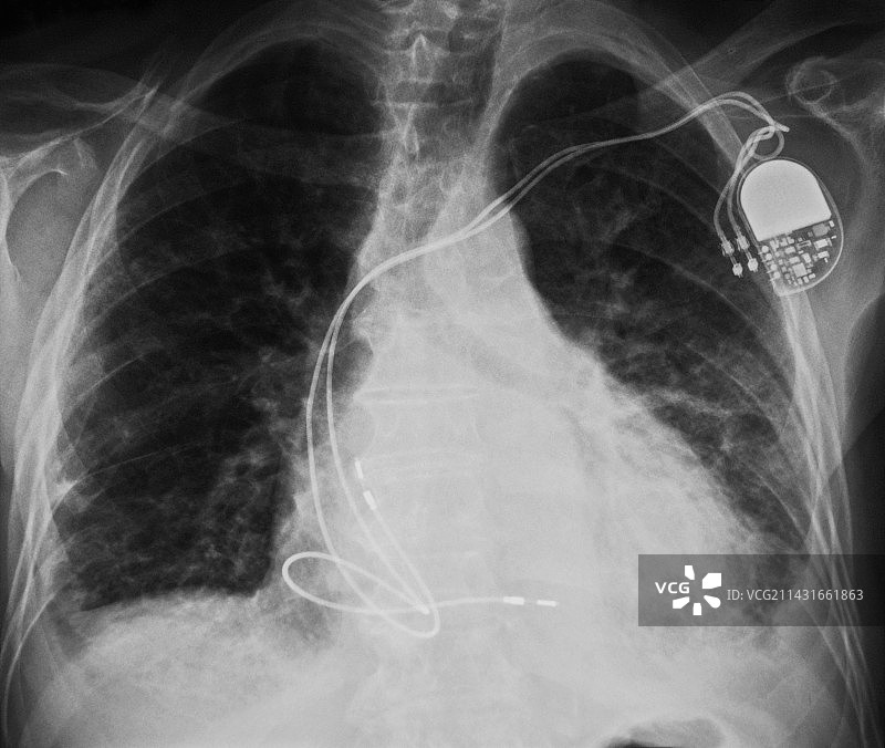 心脏起搏器，x光图片素材