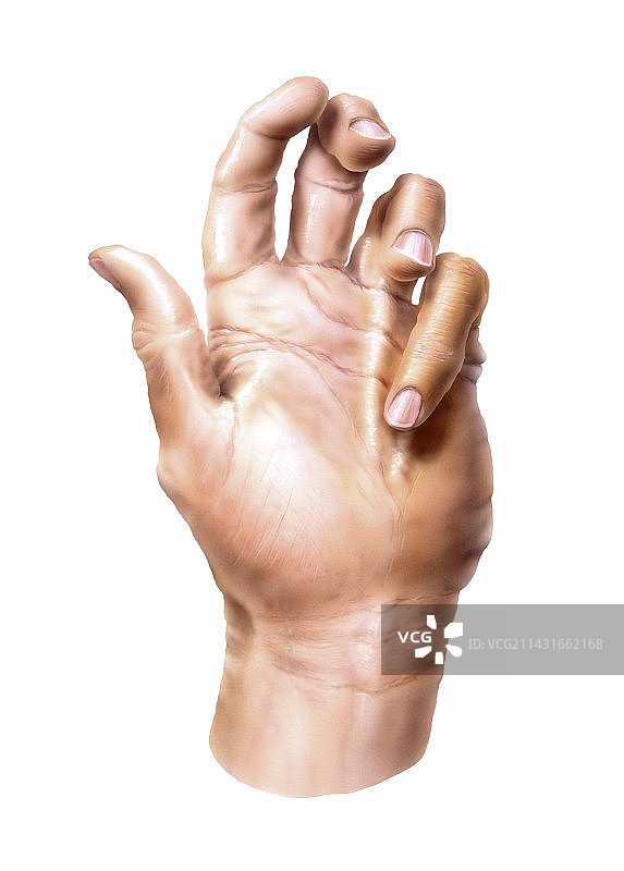 杜普伊特伦挛缩症图片素材