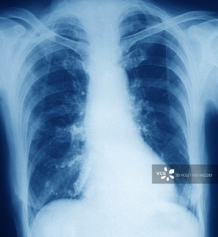肺炎X光片图片素材