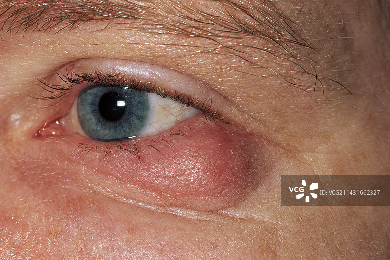 眼睑肿胀图片素材