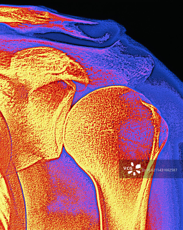 肩关节X光片图片素材