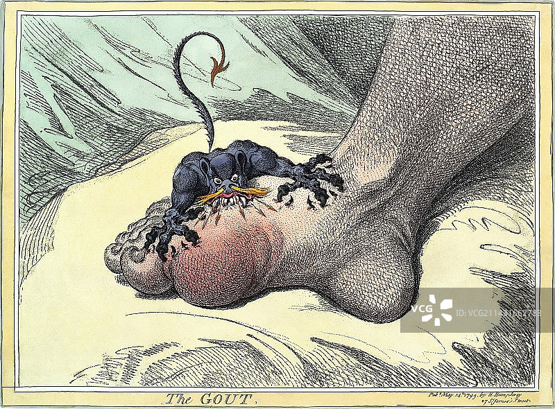 痛风,18世纪漫画图片素材