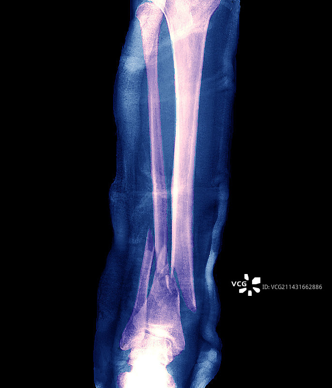 腿部骨折X光片图片素材