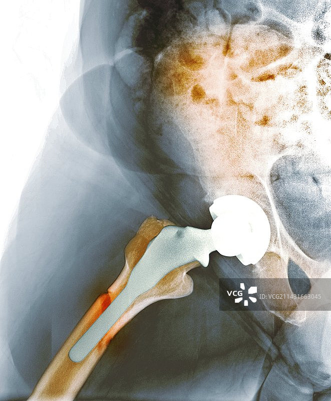 髋关节表面置换术失败X光片图片素材