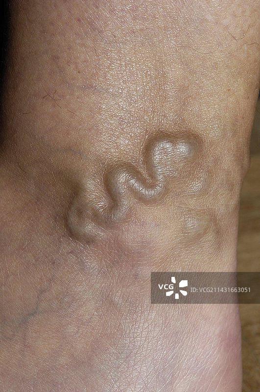 腿部的静脉曲张图片素材