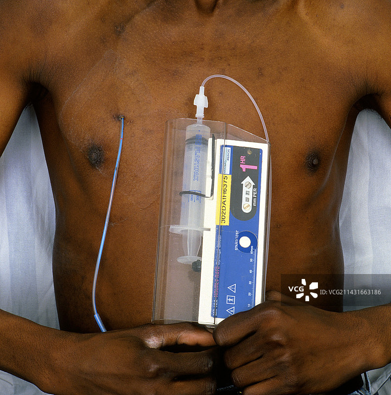 用于治疗镰状细胞贫血的药物泵图片素材