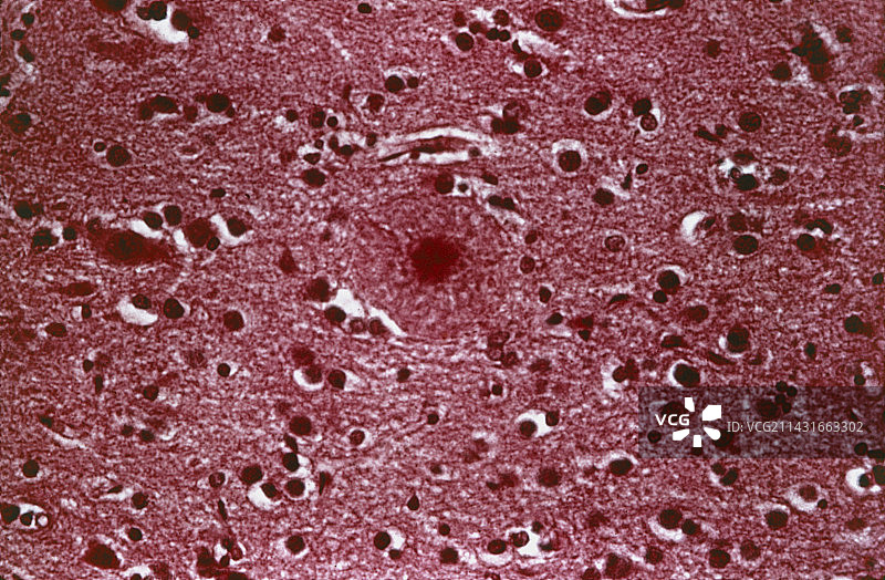 阿尔茨海默病脑组织图片素材