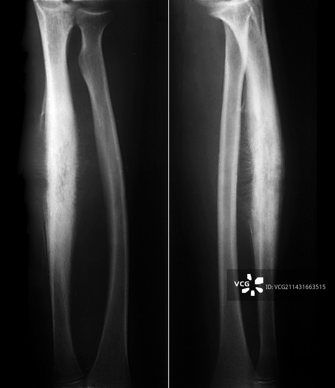 尤文氏肉瘤X光片图片素材