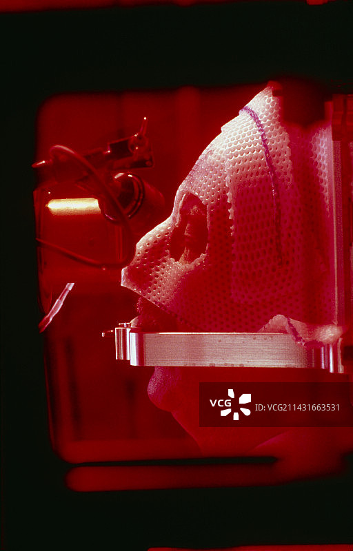 用于眼癌的质子治疗：治疗正在进行中图片素材