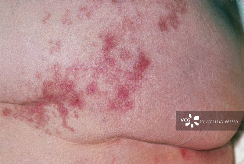 带状疱疹疤痕的成年人臀部特写图片素材