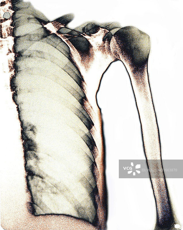 健康的肺部X光片图片素材