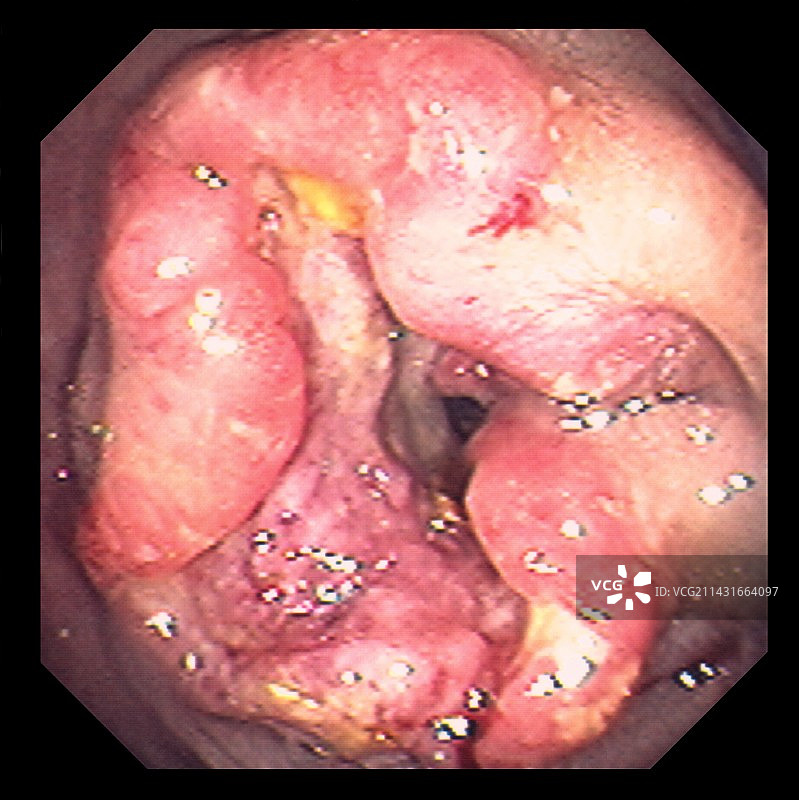 结肠癌图片素材