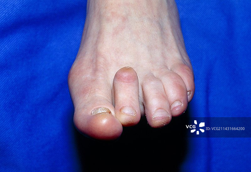 锤状趾图片素材