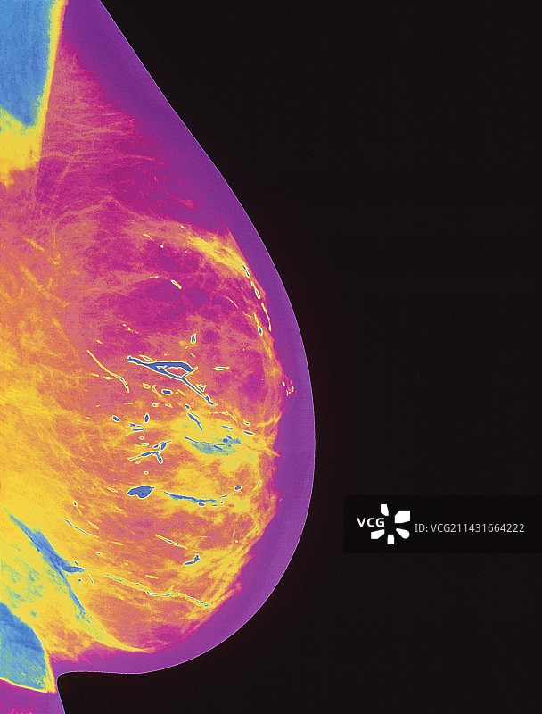 乳腺炎X光片图片素材