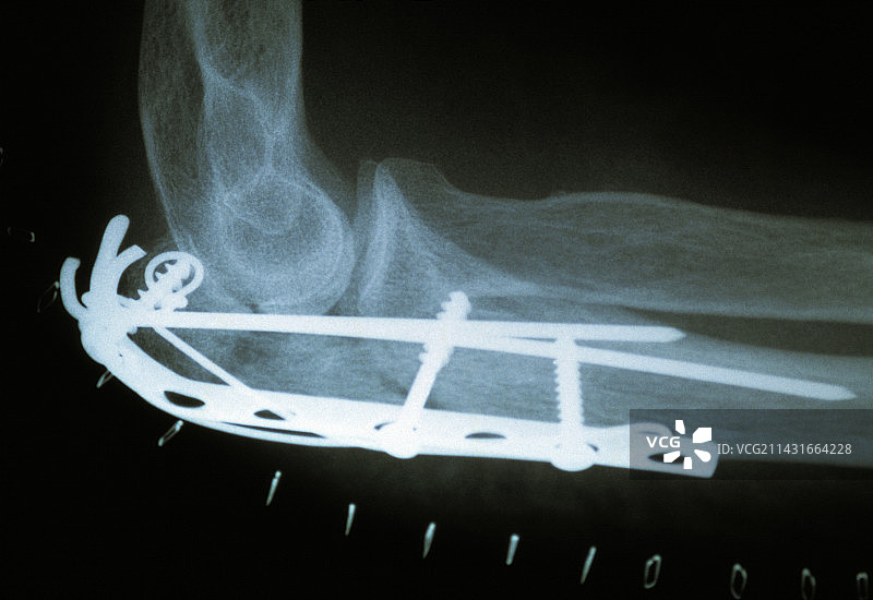 肘部骨折内固定术，X光片图片素材