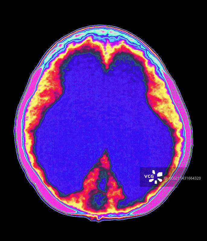 脑积水CT扫描图片素材