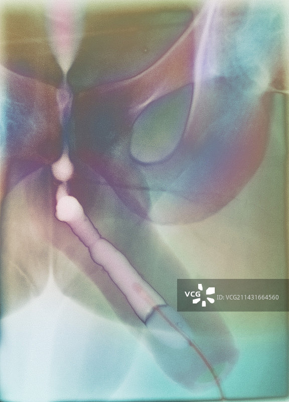 尿道炎X光片图片素材