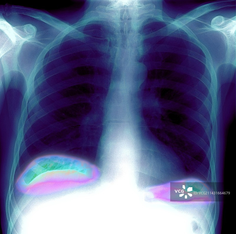 腹部气袋X光片图片素材
