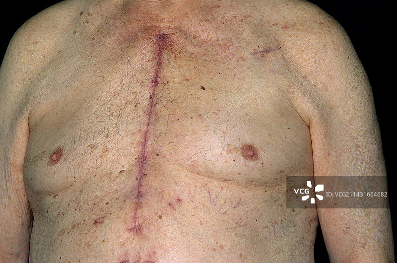 心脏手术疤痕图片素材