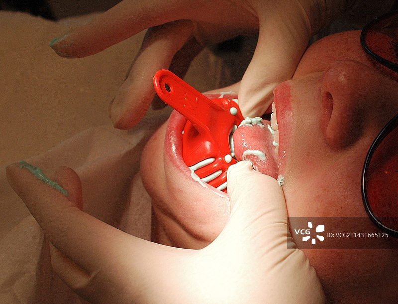 牙科印模图片素材