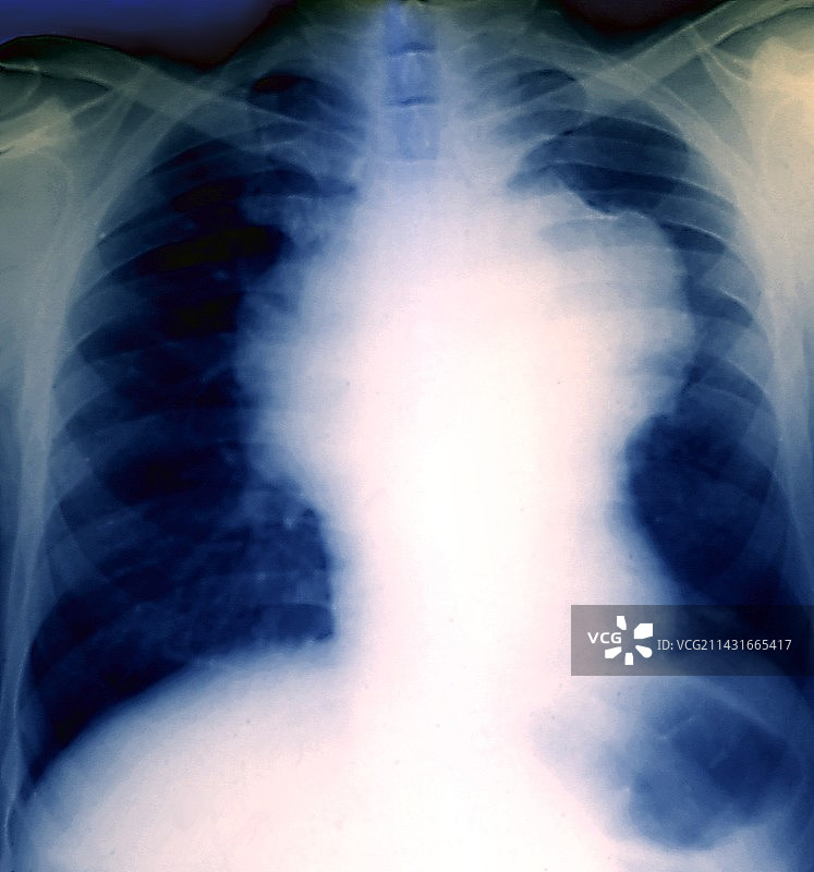 非霍奇金淋巴瘤X光片图片素材