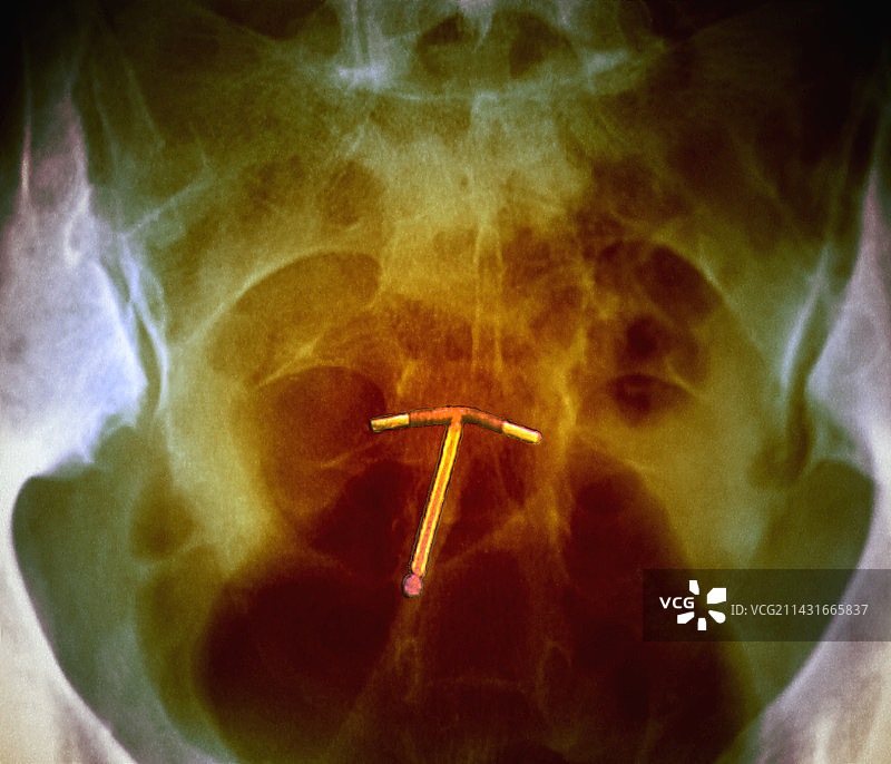 宫内节育器避孕X光片图片素材