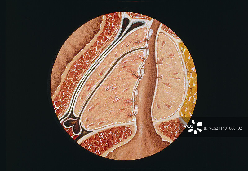 前列腺炎症图片素材