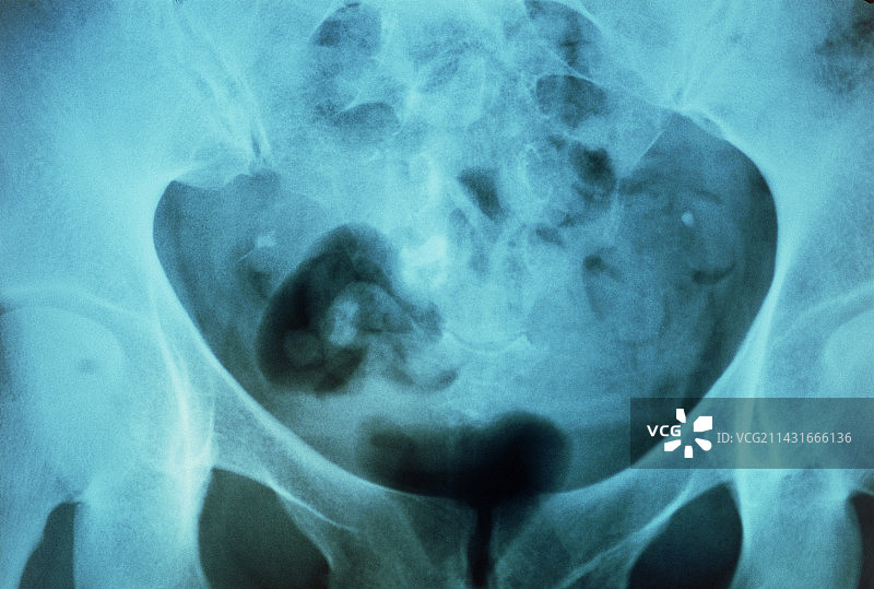 显示含牙齿皮样囊肿的骨盆X光片图片素材