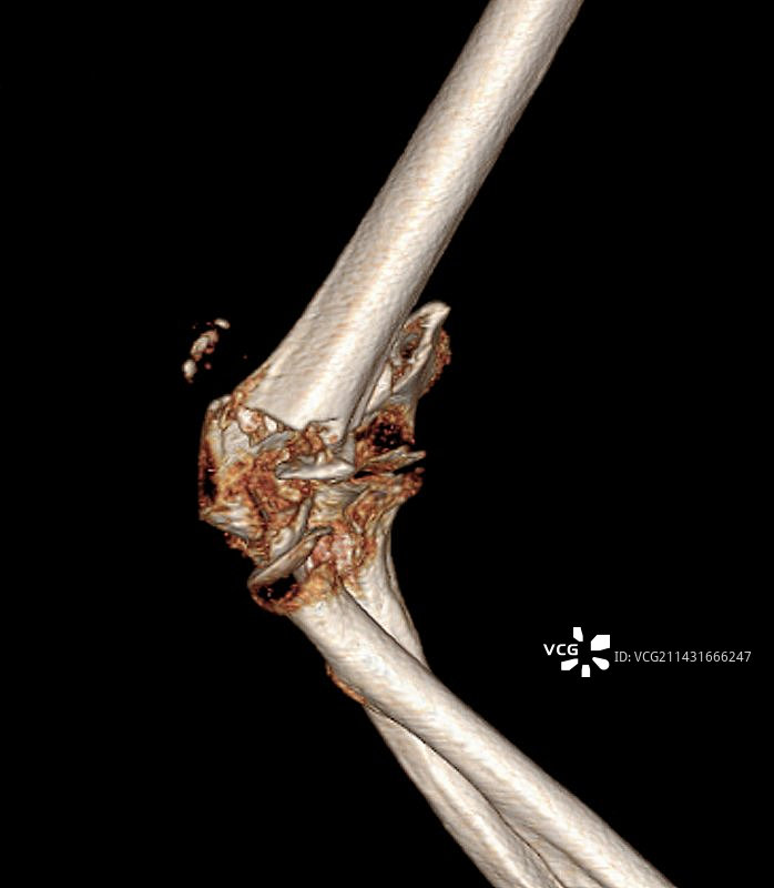 肘部骨折，CT扫描图片素材