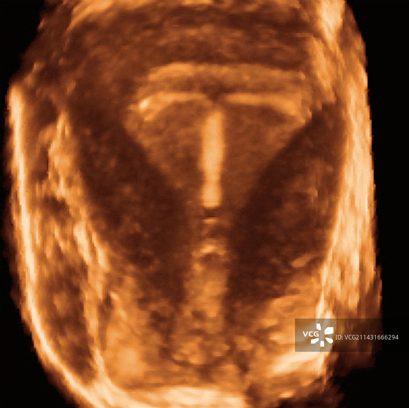 宫内节育器超声扫描图片素材