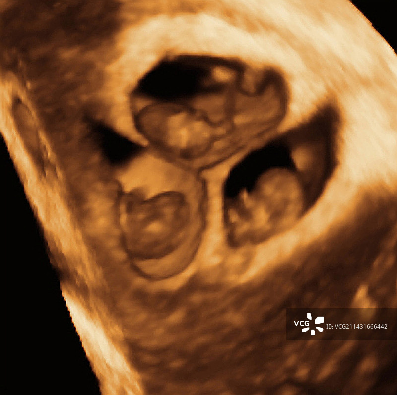 三胞胎3D超声扫描图片素材