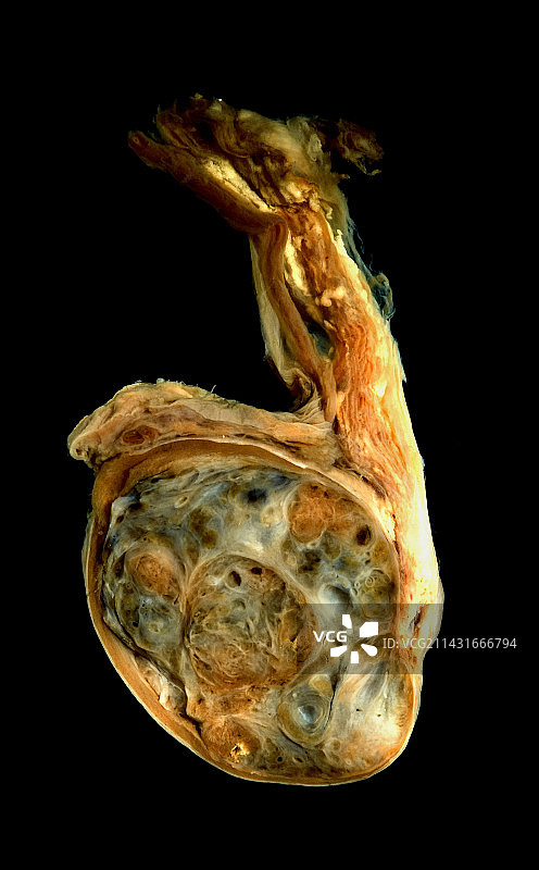 睾丸癌图片素材