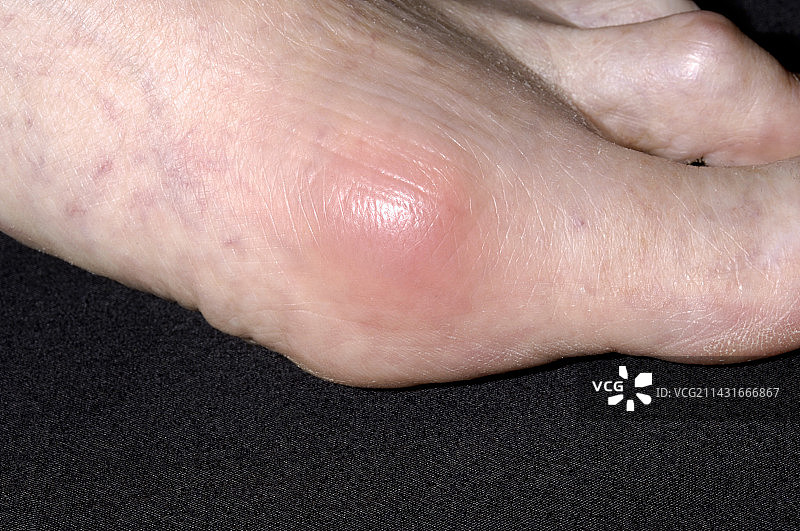 痛风关节炎症图片素材