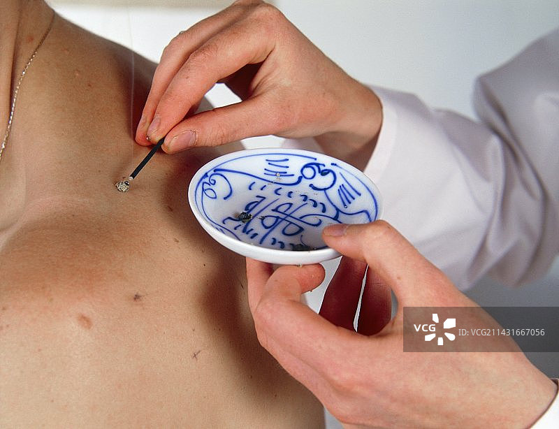 患者接受针灸治疗图片素材