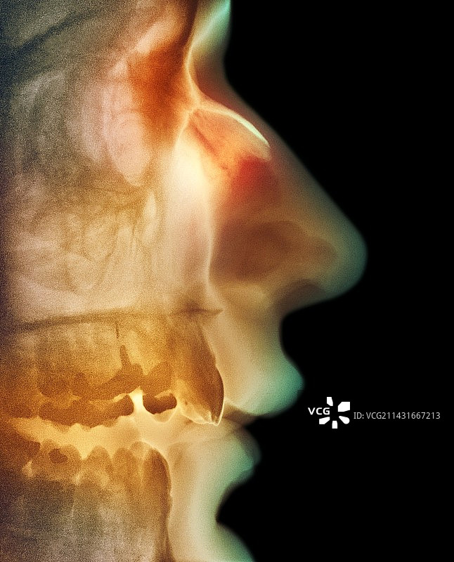 鼻骨骨折X光片图片素材