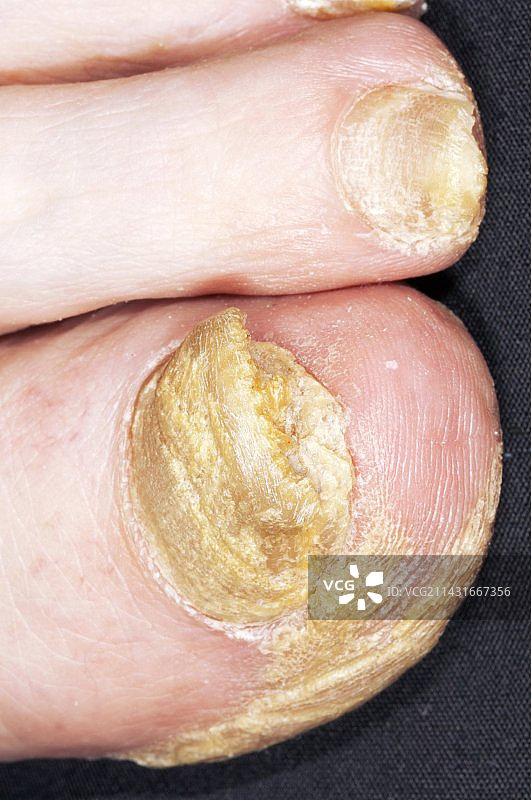 脚趾甲的真菌感染图片素材