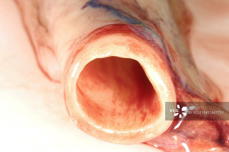 颈动脉，尸检图片素材