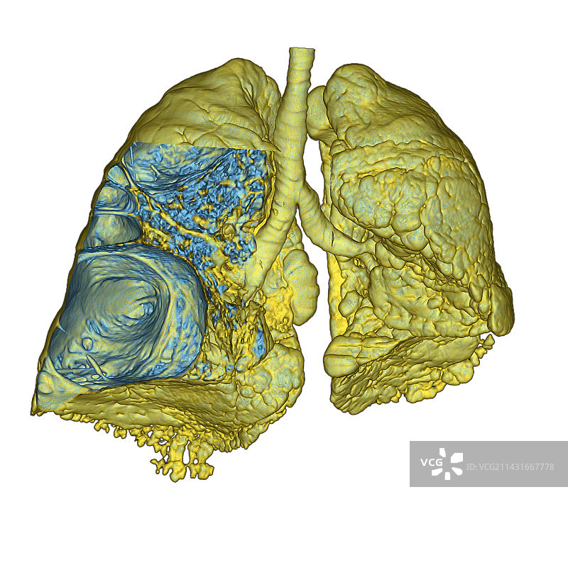 肺气肿CT扫描图片素材