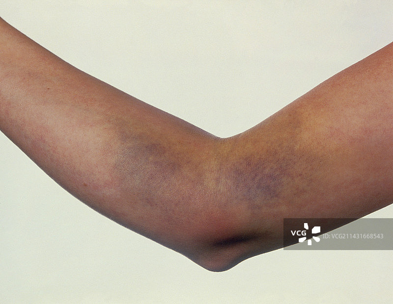 女子手臂抽血后的瘀伤图片素材
